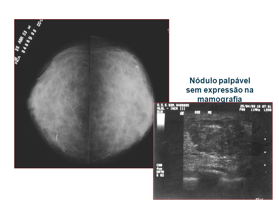 Nódulo palpável sem expressão na mamografia
