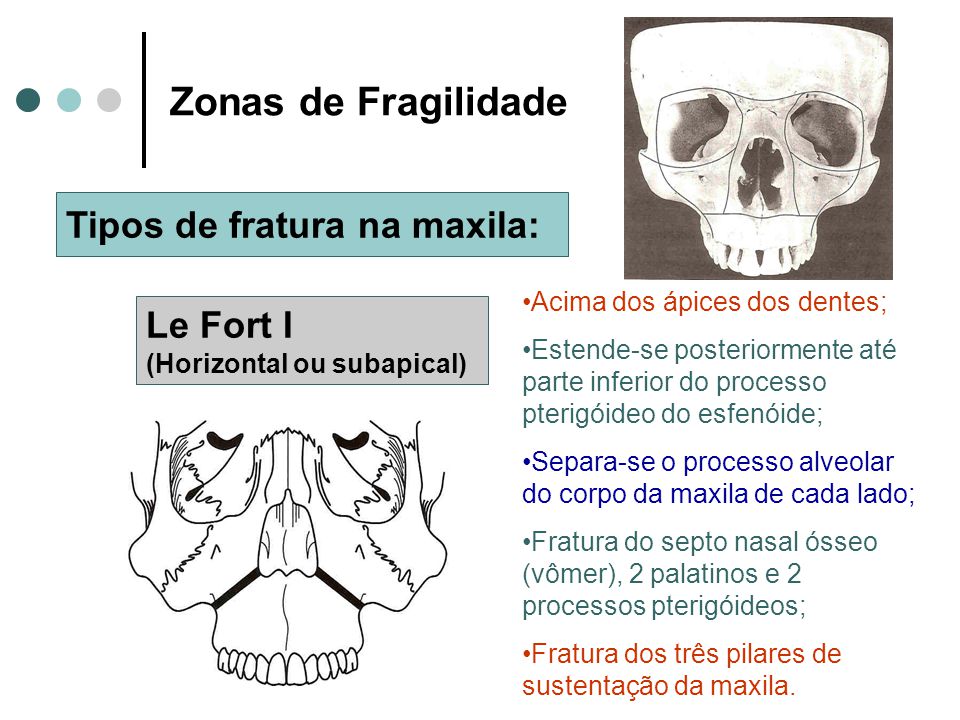 Zonas de Fragilidade Tipos de fratura na maxila: Le Fort I
