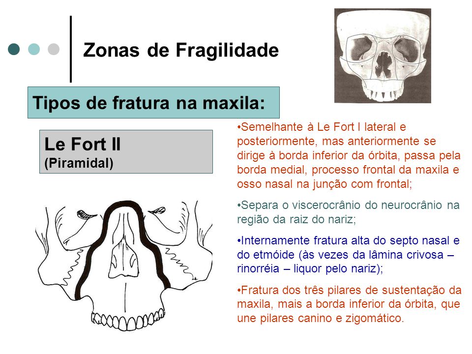 Zonas de Fragilidade Tipos de fratura na maxila: Le Fort II