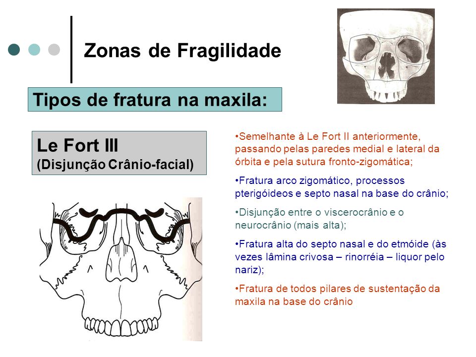 Zonas de Fragilidade Tipos de fratura na maxila: Le Fort III