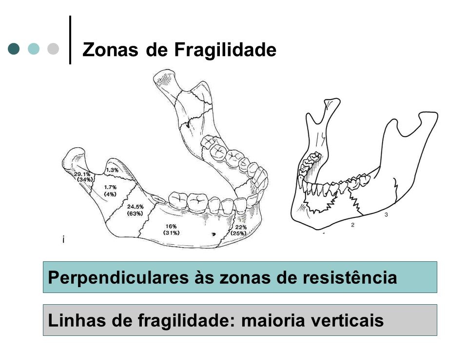 Zonas de Fragilidade Perpendiculares às zonas de resistência
