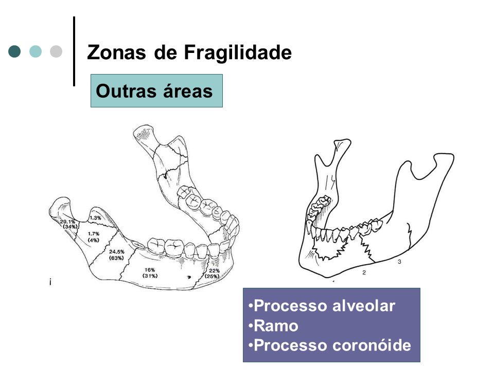Zonas de Fragilidade Outras áreas Processo alveolar Ramo