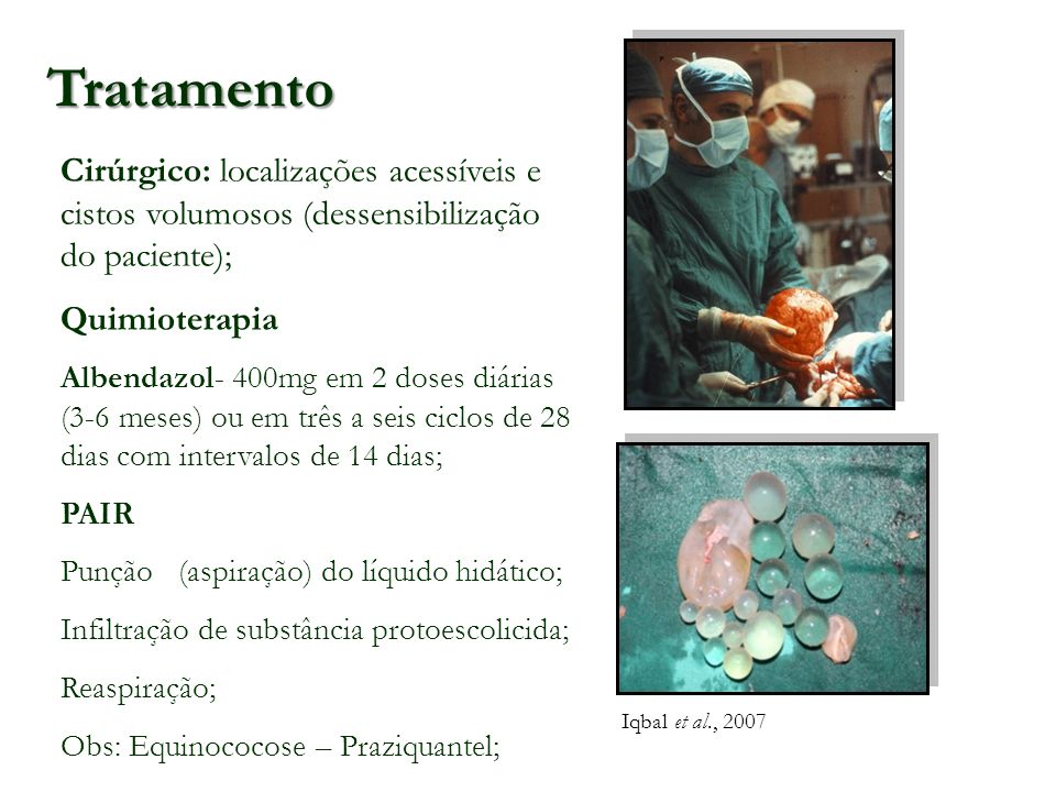 Tratamento Cirúrgico: localizações acessíveis e cistos volumosos (dessensibilização do paciente); Quimioterapia.