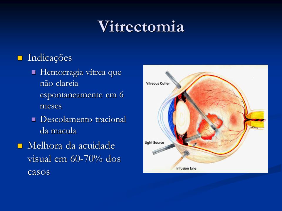 Vitrectomia Indicações Melhora da acuidade visual em 60-70% dos casos