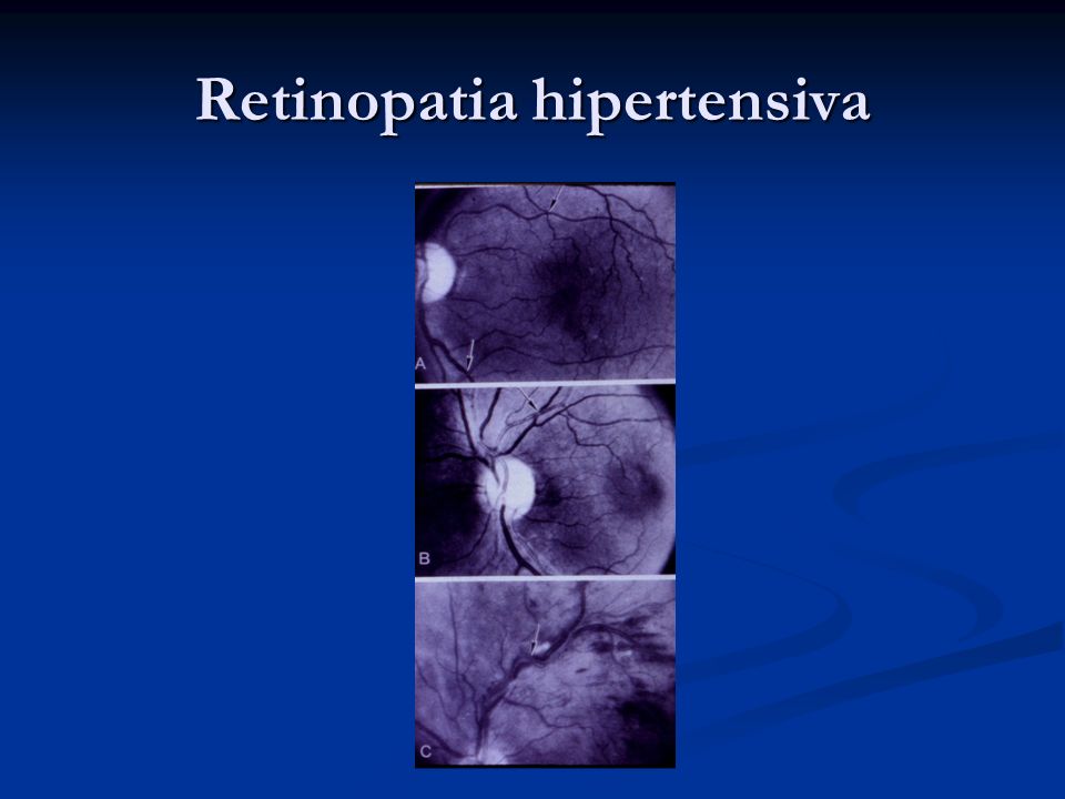 Retinopatia hipertensiva