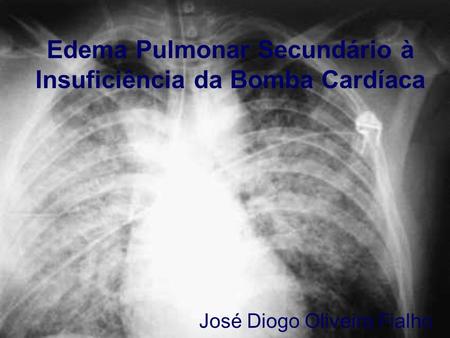 Edema Pulmonar Secundário à Insuficiência da Bomba Cardíaca