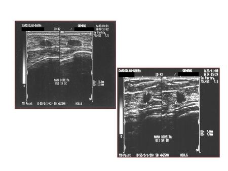 COMPLEMENTAÇÃO MAMOGRAFIA - ULTRA-SONOGRAFIA Complementação adequada Nódulo palpável não identificado na mamografia (alta densidade do parênquima.