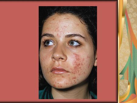 ACNE “A acne é uma doença inflamatória, caracterizada por constrangimento,vergonha, culpa, ansiedade, depressão, frustração, raiva e pústulas”. (J. Ellis)