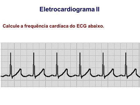 Eletrocardiograma II Calcule a frequência cardíaca do ECG abaixo.