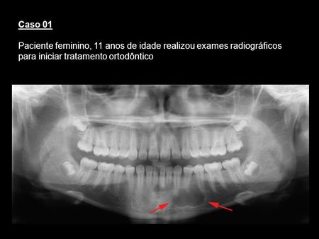 Caso 01 Paciente feminino, 11 anos de idade realizou exames radiográficos para iniciar tratamento ortodôntico Cisto ósseo traumatico Paciente femenino.