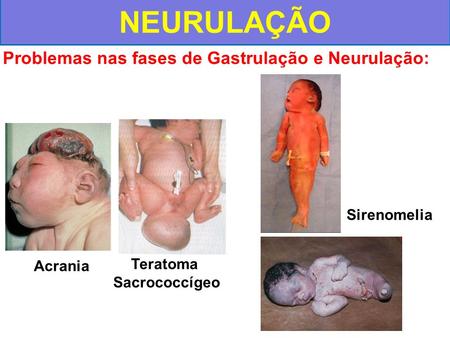 NEURULAÇÃO Problemas nas fases de Gastrulação e Neurulação:
