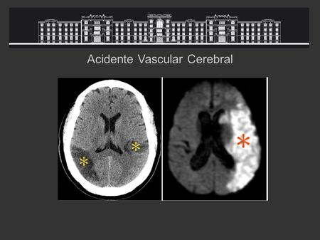 Acidente Vascular Cerebral. Sistema Carotídeo Sistema Vértebro-Basilar.