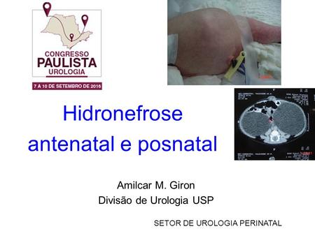 Hidronefrose antenatal e posnatal Amilcar M. Giron Divisão de Urologia USP SETOR DE UROLOGIA PERINATAL.