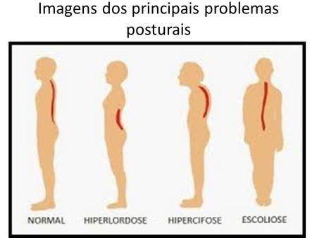 Imagens dos principais problemas posturais. Posturas normais.
