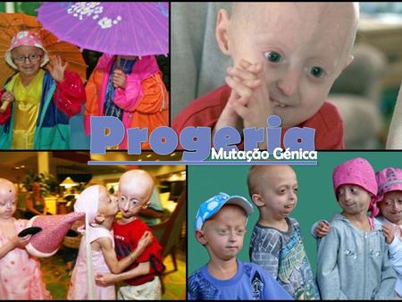 Progeria Mutação Génica.