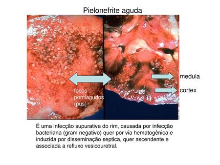 Pielonefrite aguda medula cortex focos pontiagudos (pus)