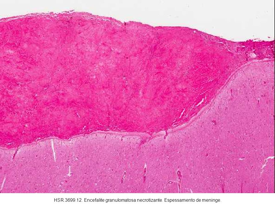 HSR Encefalite granulomatosa necrotizante