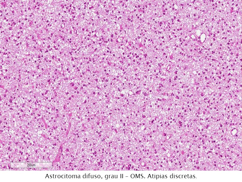 Astrocitoma difuso, grau II – OMS. Atipias discretas.