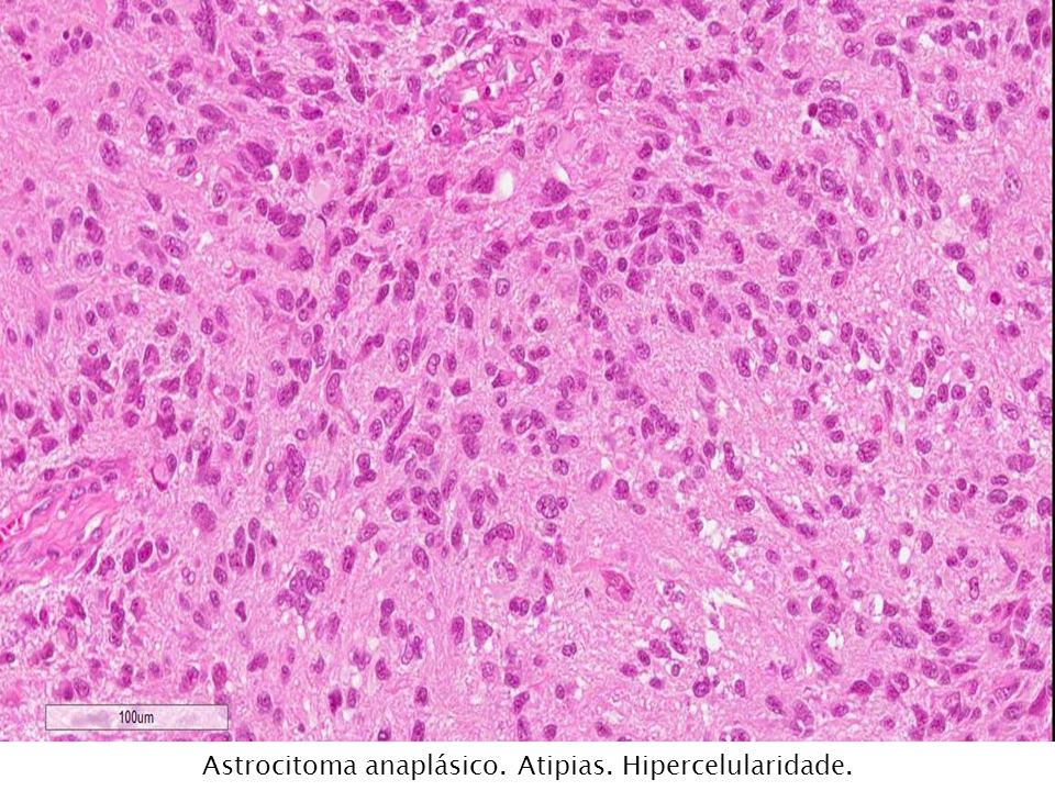 Astrocitoma anaplásico. Atipias. Hipercelularidade.
