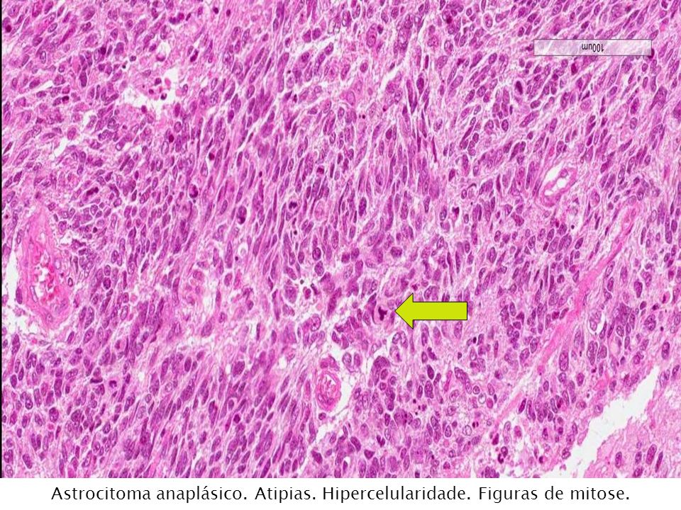 Astrocitoma anaplásico. Atipias. Hipercelularidade. Figuras de mitose.