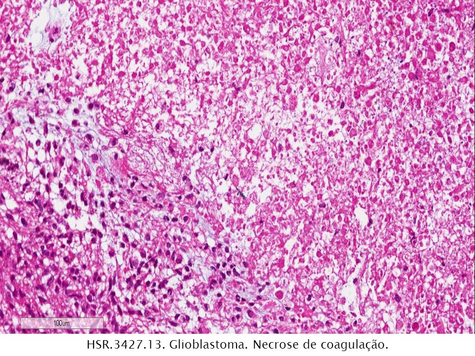 HSR Glioblastoma. Necrose de coagulação.