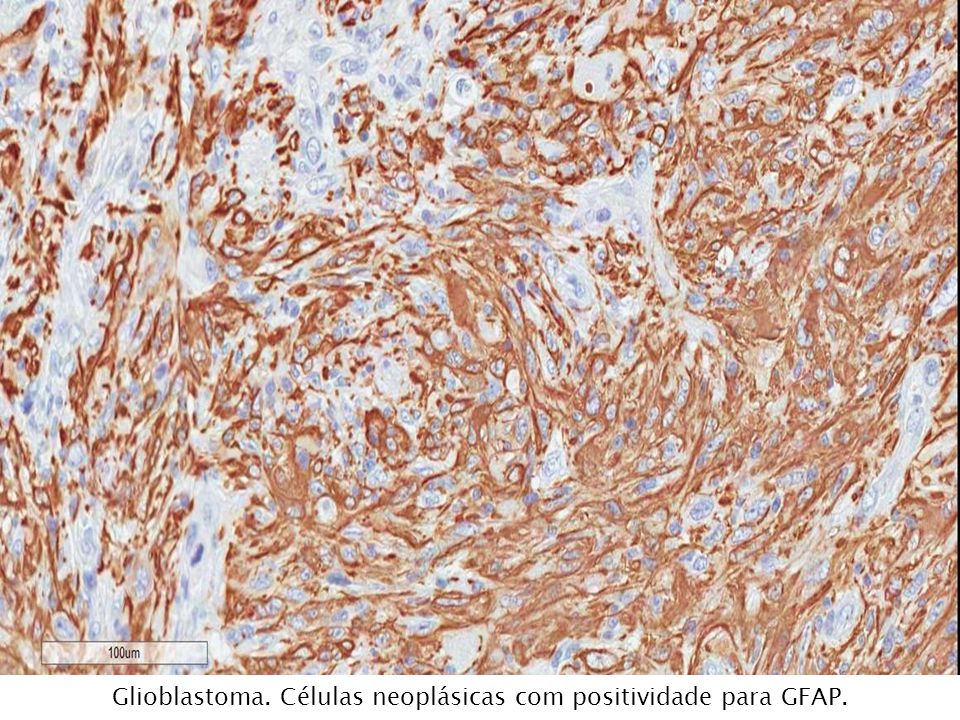 Glioblastoma. Células neoplásicas com positividade para GFAP.