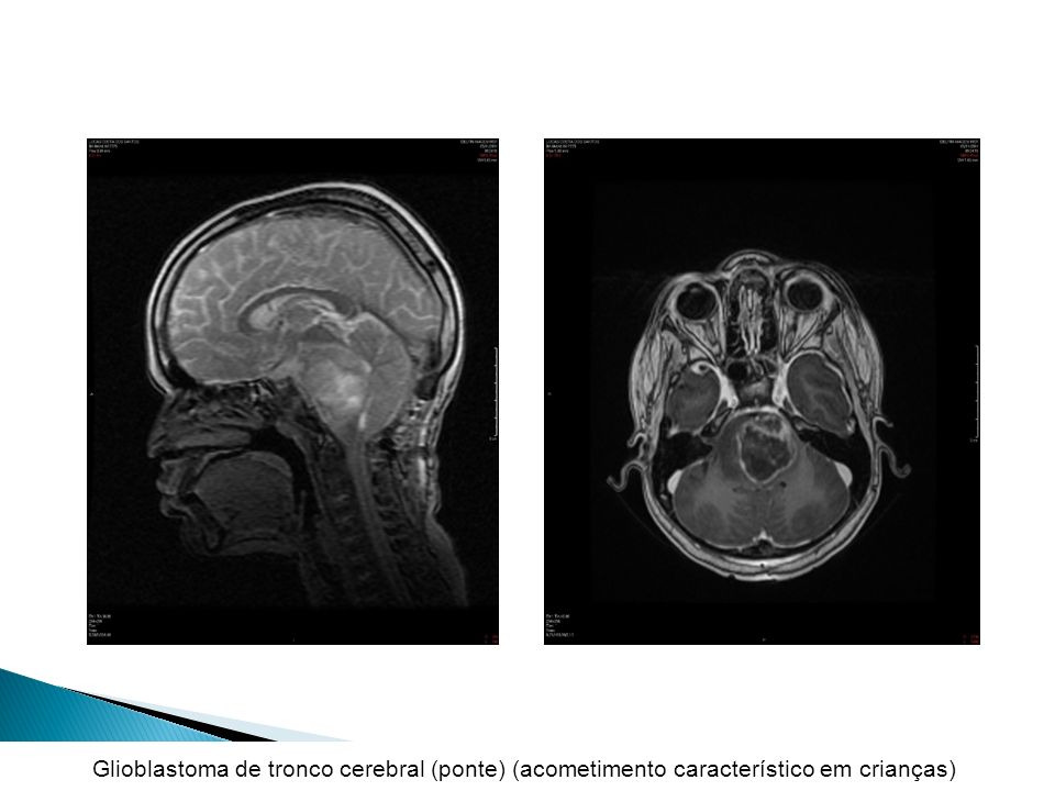 Glioblastoma de tronco cerebral (ponte) (acometimento característico em crianças))