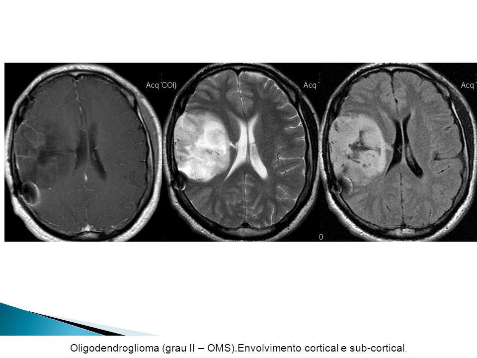 Oligodendroglioma (grau II – OMS).Envolvimento cortical e sub-cortical.