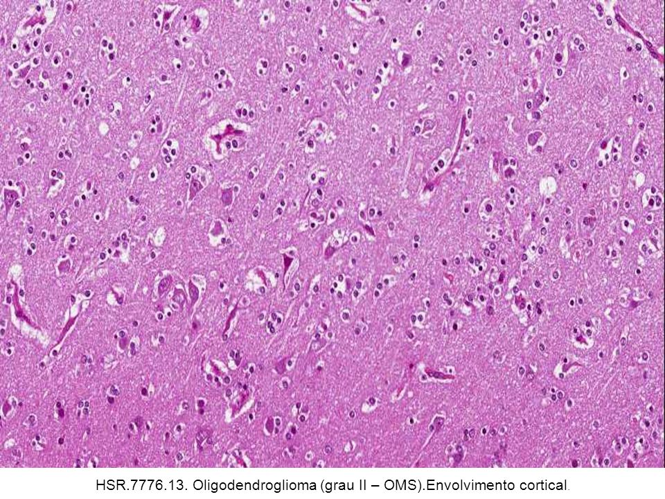 HSR Oligodendroglioma (grau II – OMS).Envolvimento cortical.