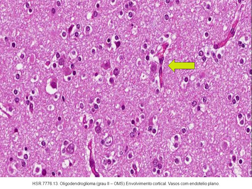 HSR Oligodendroglioma (grau II – OMS).Envolvimento cortical. Vasos com endotelio plano.