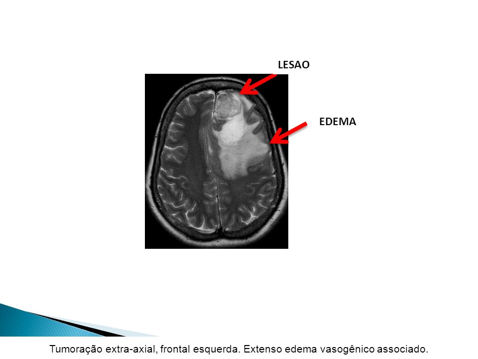 LESAO EDEMA Tumoração extra-axial, frontal esquerda. Extenso edema vasogênico associado. 6