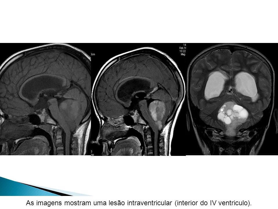 As imagens mostram uma lesão intraventricular (interior do IV ventriculo).