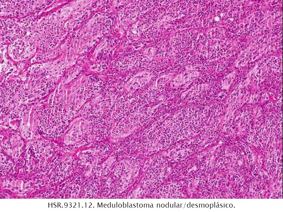 HSR Meduloblastoma nodular/desmoplásico.