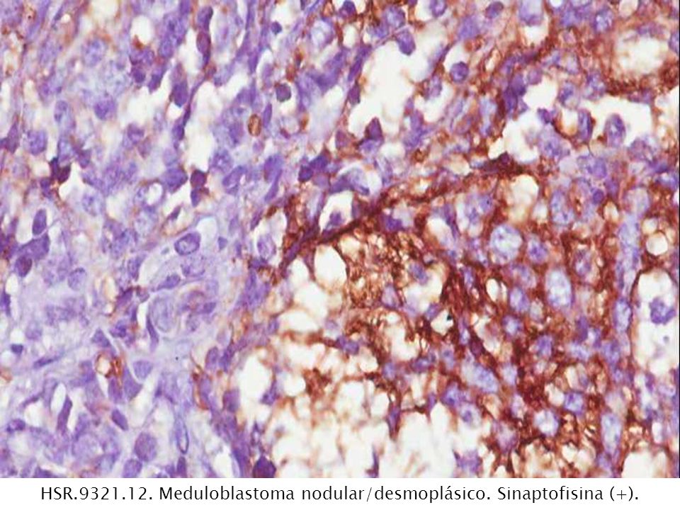 HSR Meduloblastoma nodular/desmoplásico. Sinaptofisina (+).