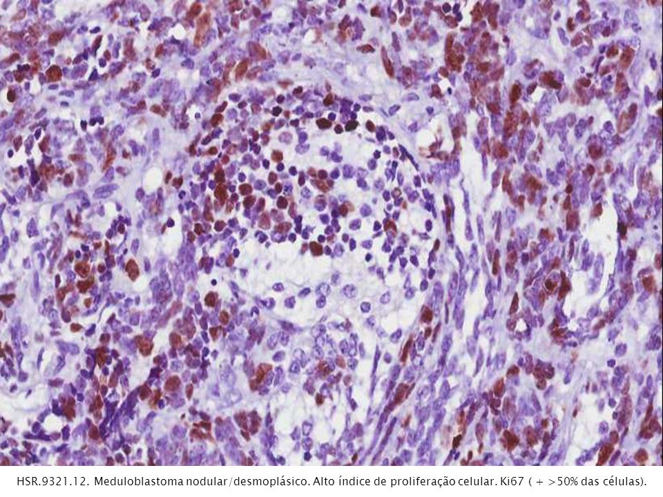 HSR Meduloblastoma nodular/desmoplásico