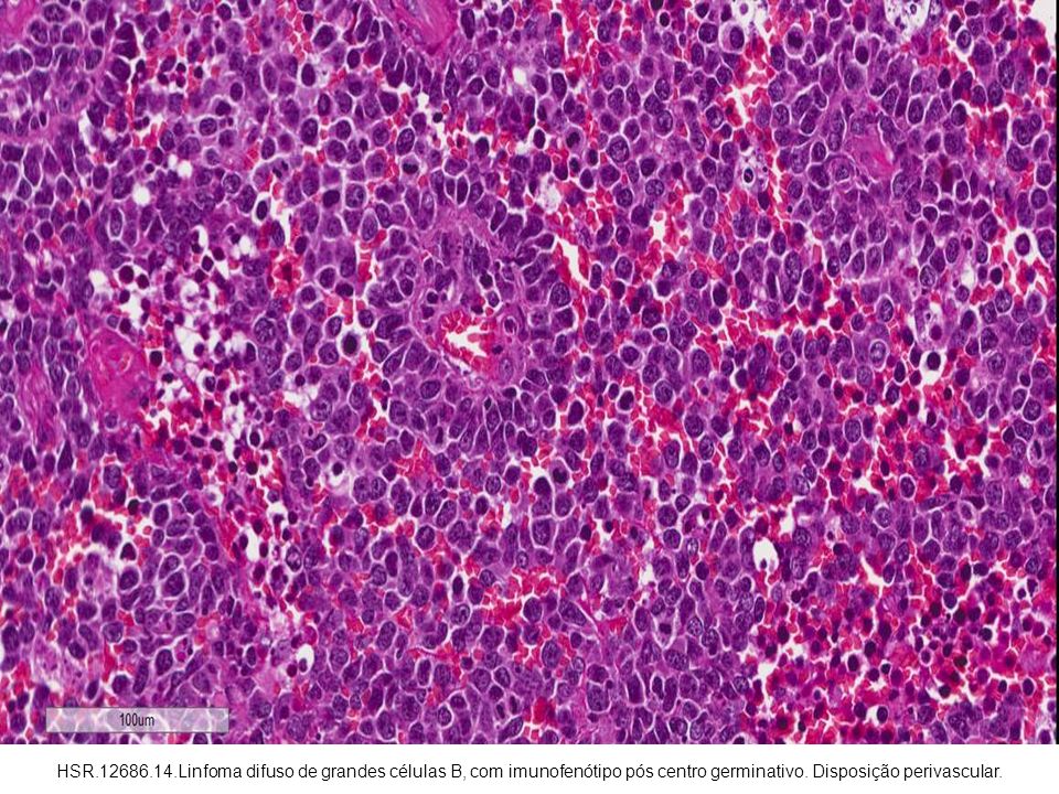 HSR Linfoma difuso de grandes células B, com imunofenótipo pós centro germinativo.