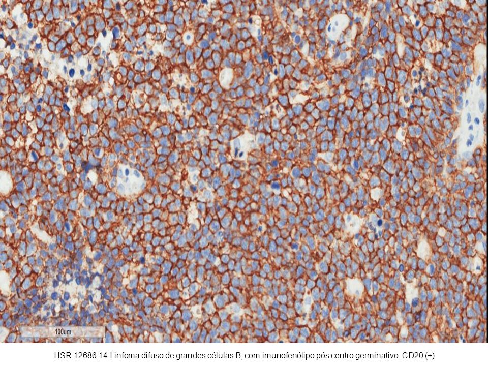 HSR Linfoma difuso de grandes células B, com imunofenótipo pós centro germinativo. CD20 (+)