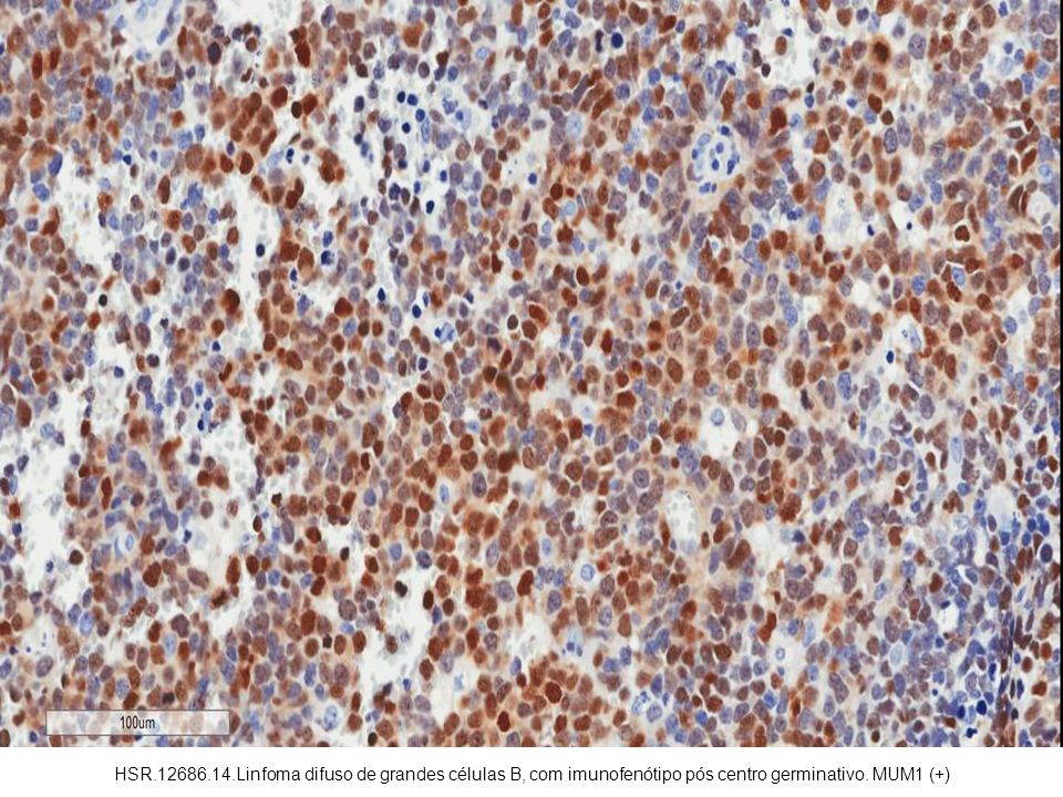 HSR Linfoma difuso de grandes células B, com imunofenótipo pós centro germinativo. MUM1 (+)
