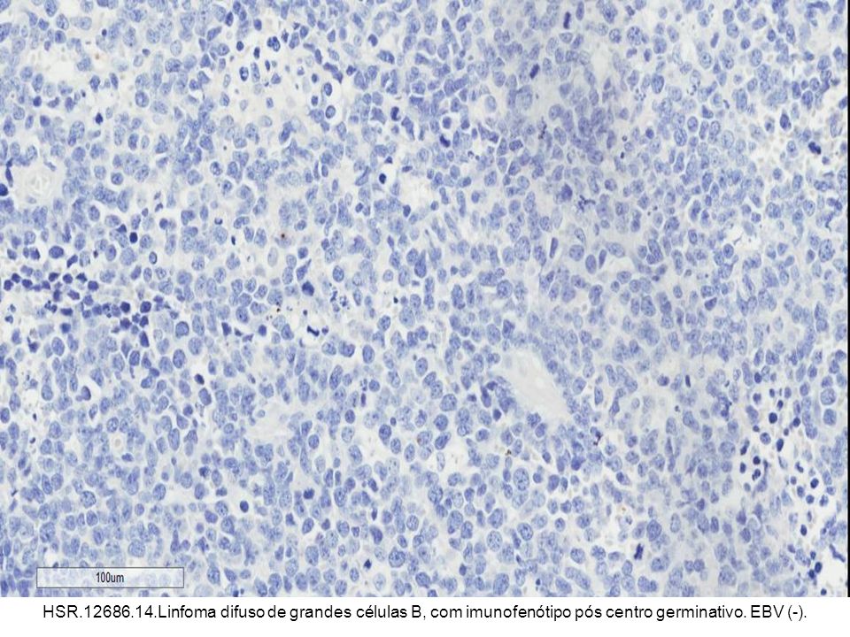 HSR Linfoma difuso de grandes células B, com imunofenótipo pós centro germinativo. EBV (-).