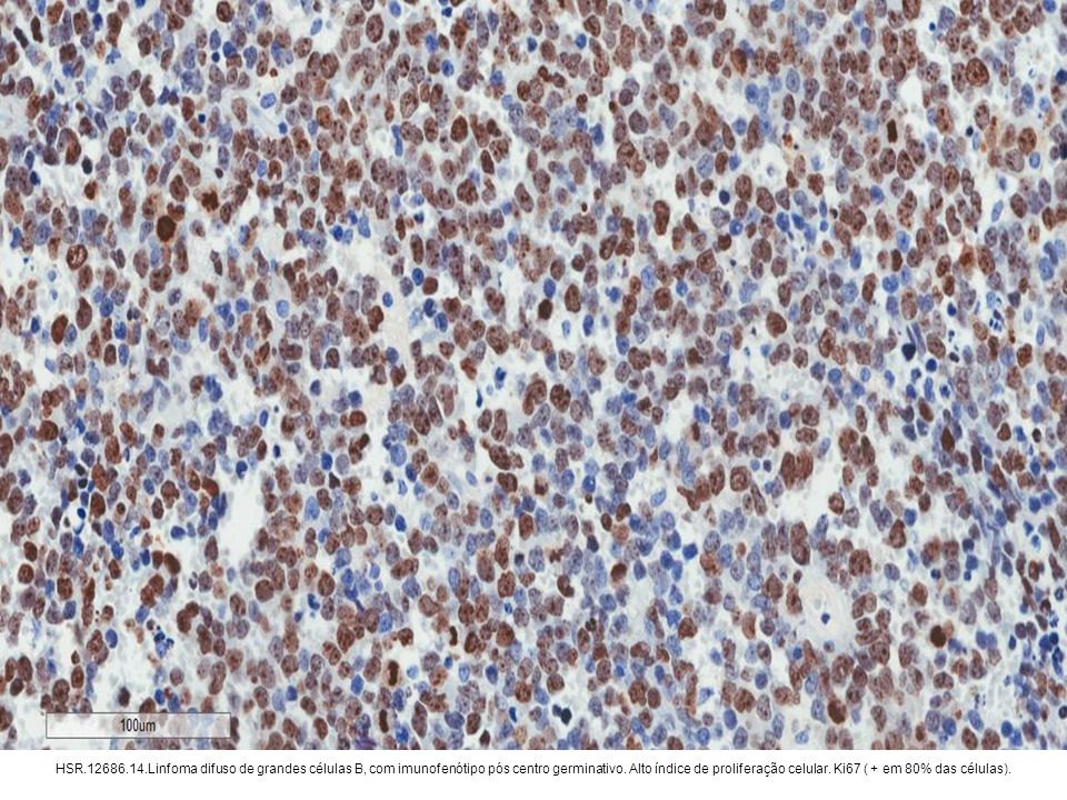 HSR Linfoma difuso de grandes células B, com imunofenótipo pós centro germinativo.
