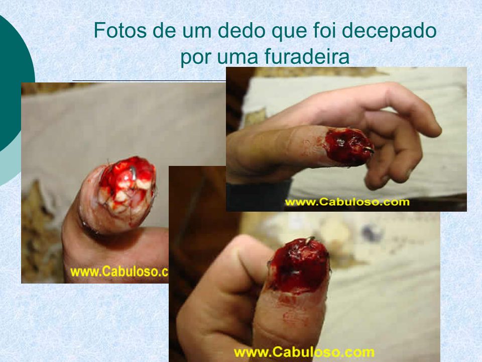 Fotos de um dedo que foi decepado por uma furadeira