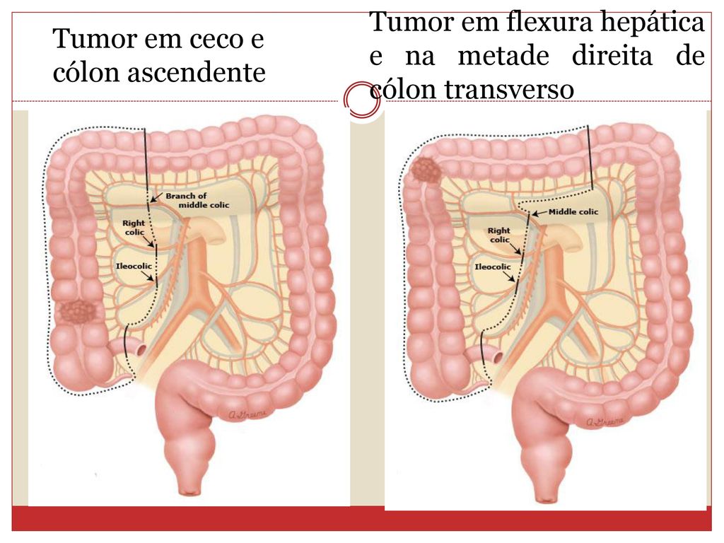 cancer de colon giardia