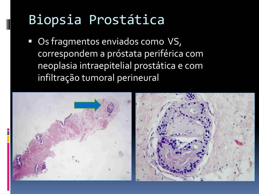 invazie perineurala prostata)