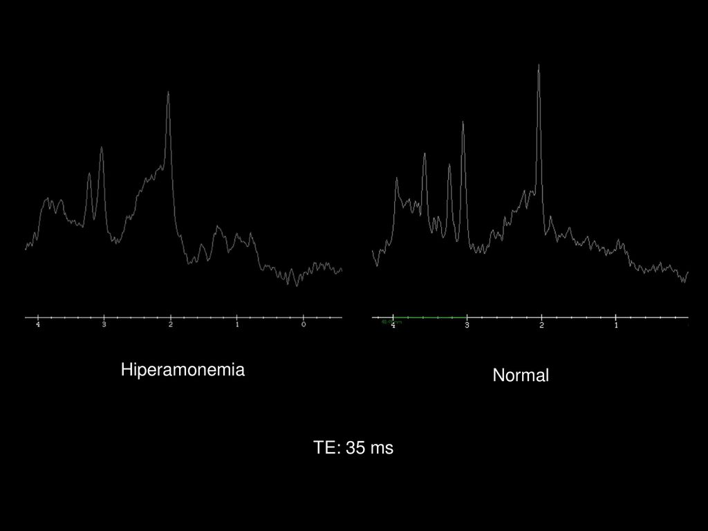 Hiperamonemia Normal TE: 35 ms
