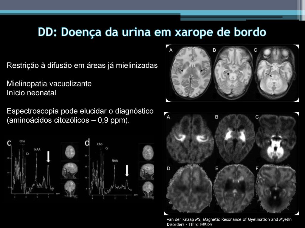 Doença da urina do xarope do bordo: conheça a leucinose. – Bruzaca