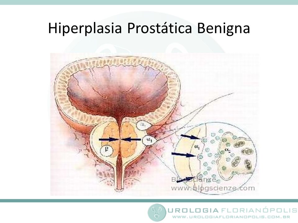 hiperplasia prostatica beningna cie 10