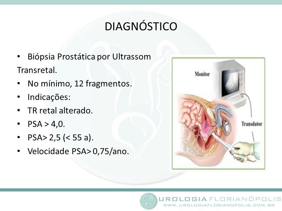DIAGNÓSTICO Biópsia Prostática por Ultrassom Transretal.