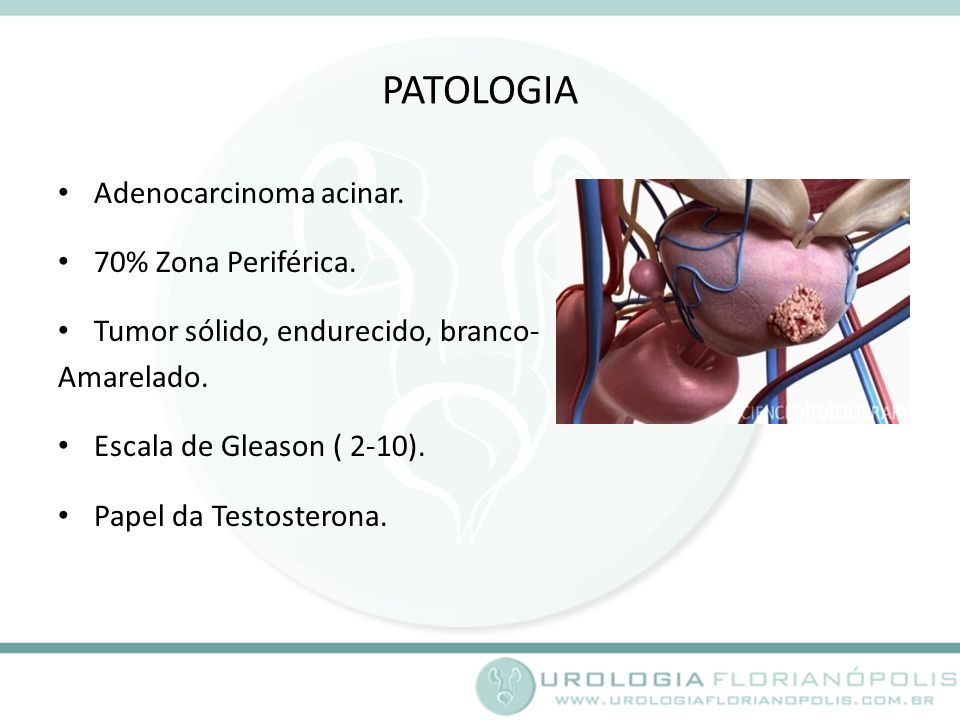 PATOLOGIA Adenocarcinoma acinar. 70% Zona Periférica.