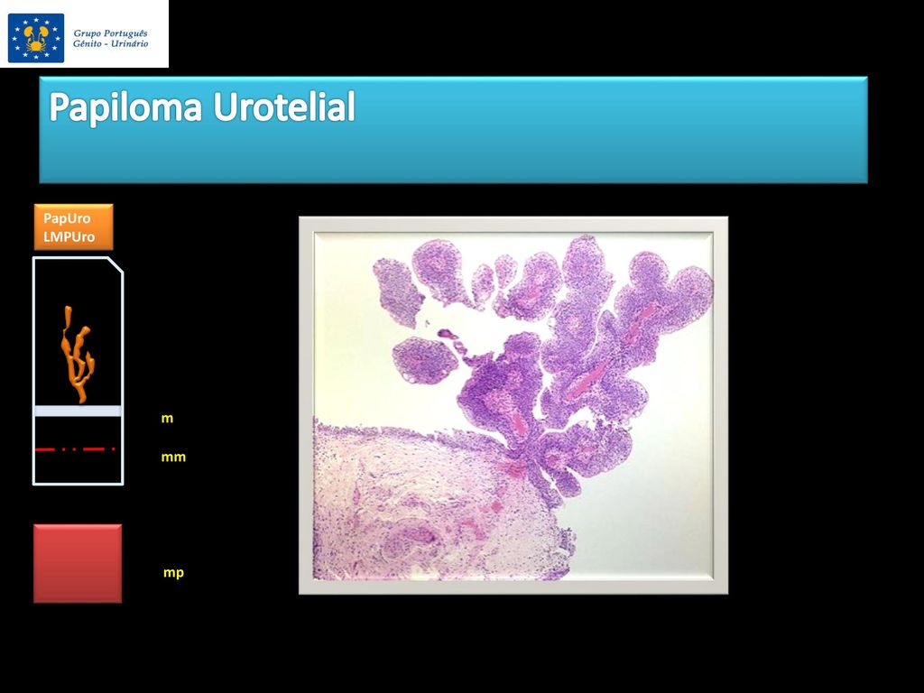papiloma urotelial tratamento vision transformer pytorch