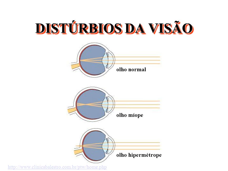 DISTÚRBIOS DA VISÃO olho normal olho míope olho hipermétrope